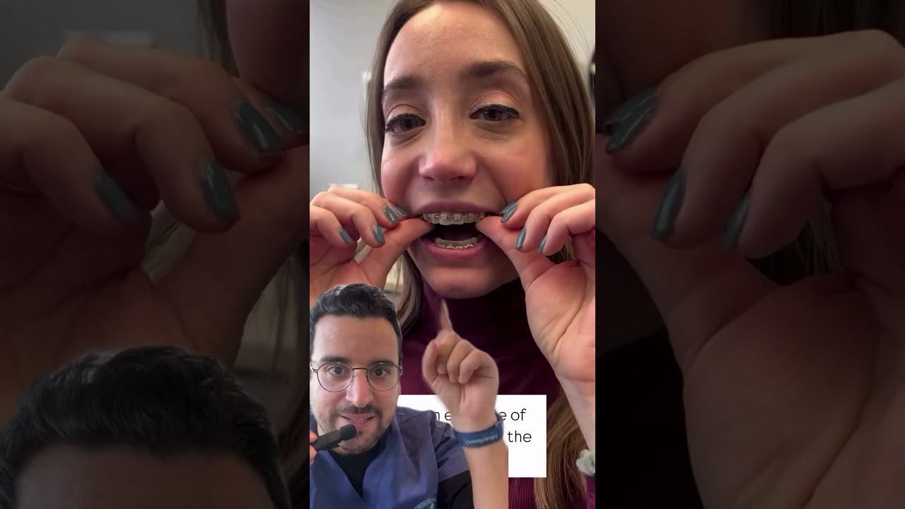 Traitement orthodontique agressif : risque pour les dents ?