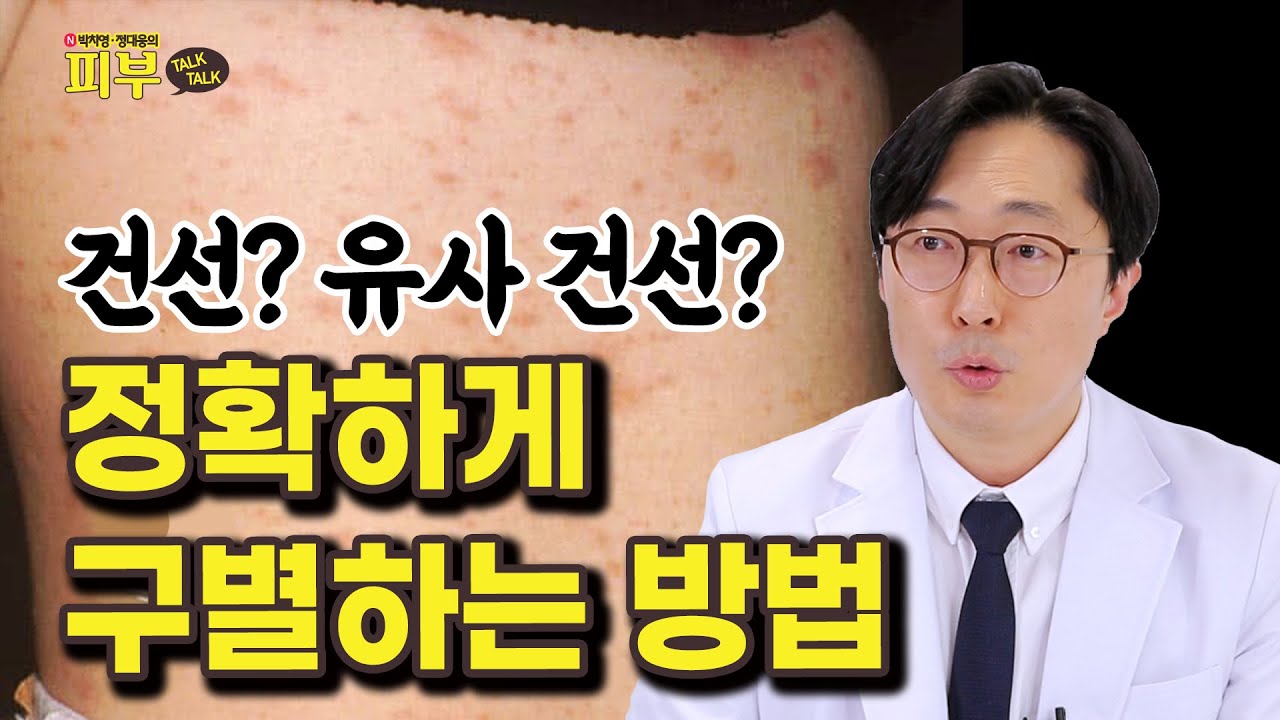 건선과 유사한 피부 질환 총집합! 헷갈린다면 ’이렇게’ 구분하세요 - 박치영, 정대웅의 피부 톡톡 #212