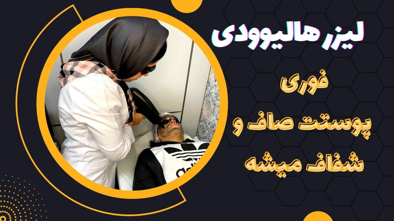 لیزر هالیوودی|با ماسک کربن|قویترین پیلینگ فوری صورت