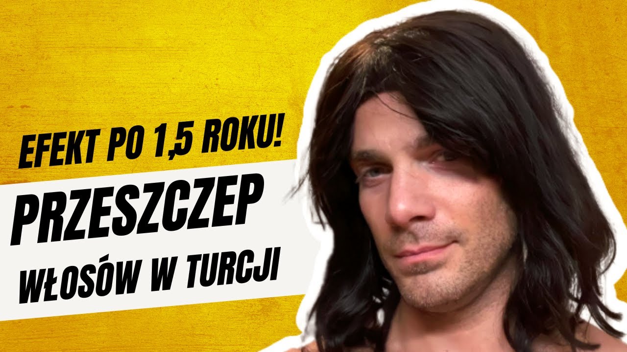 Przeszczep Włos&oacute;w Turcja - efekt po 12 miesiącach