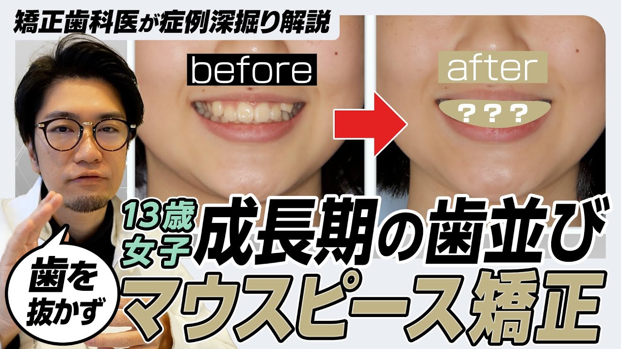 【非抜歯】出っ歯をマウスピース矯正で治療｜インビザライン症例解説