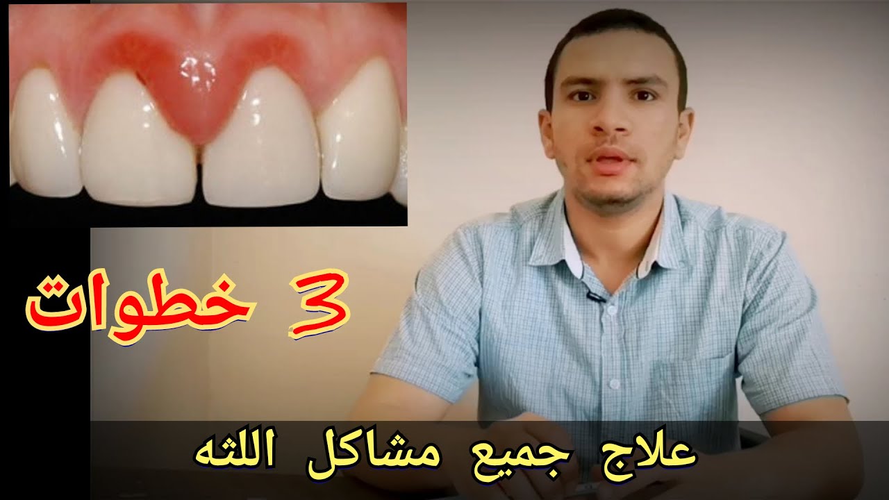 عالج جميع امراض اللثه ب ٣ خطوات بسيطه في المنزل بدون طبيب