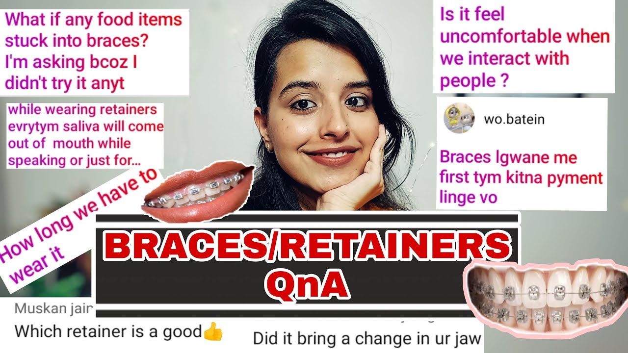 Answering all your BRACES/RETAINERS related Questions || Duration,Best Reatiners,Face Changes?