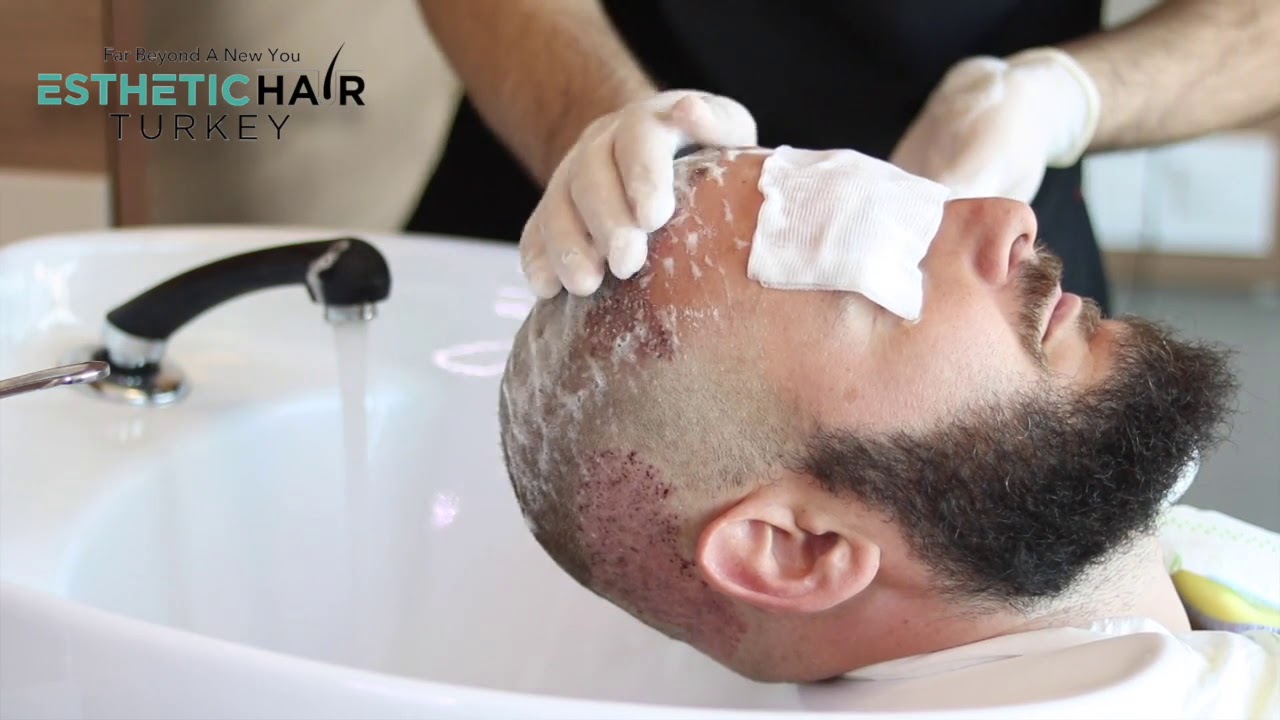 How to Wash Your Head After Hair Transplantation