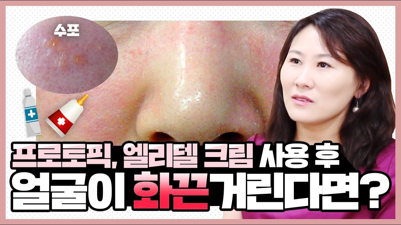 얼굴 피부염에 프로토픽, 엘리델 크림을 사용한 후 화끈거리고 따갑습니다