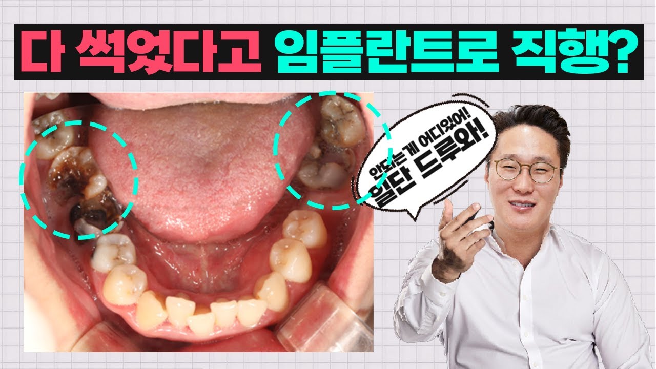 썩은 치아 다 뽑고 임플란트 할 예정이신 분들? 충치 고민 그만하고 ★일단 다 드루와~☆ (※ 나보다 심한 케이스 여기 다 있음)