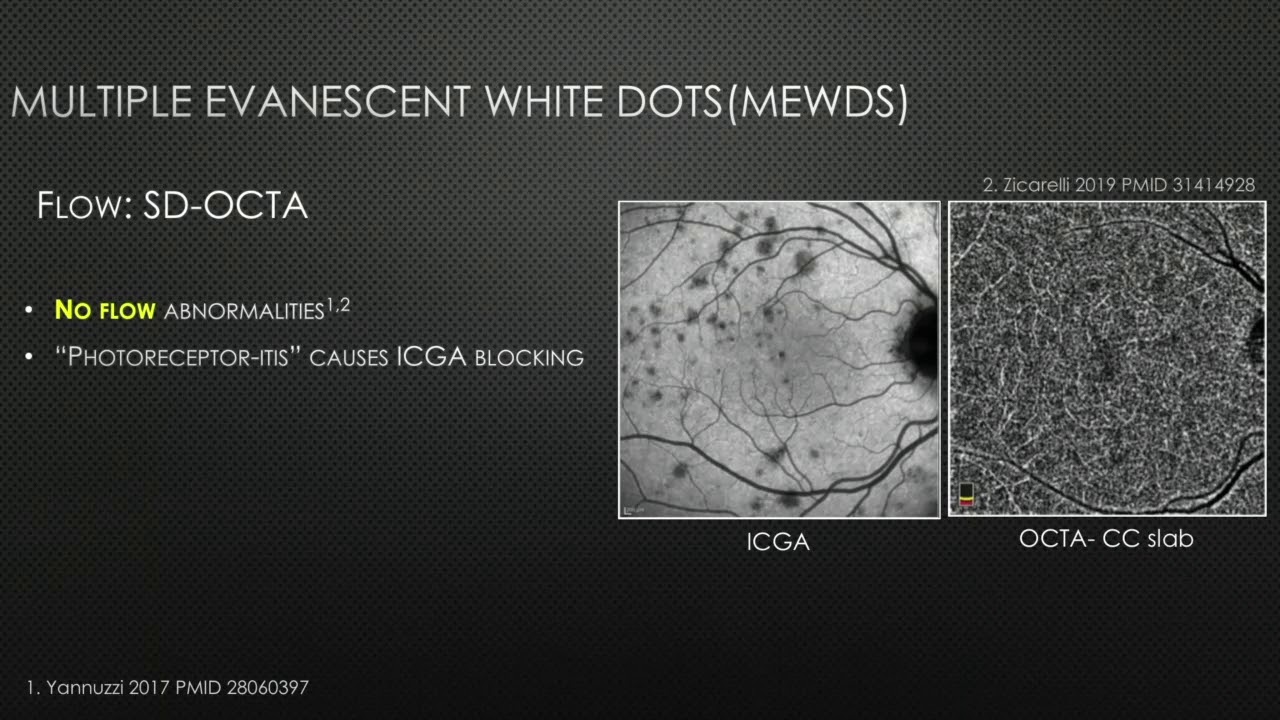 SYM39 06   White Dot Syndromes A Systematic Approach to Diagnosis   Optical Coherence Tomography