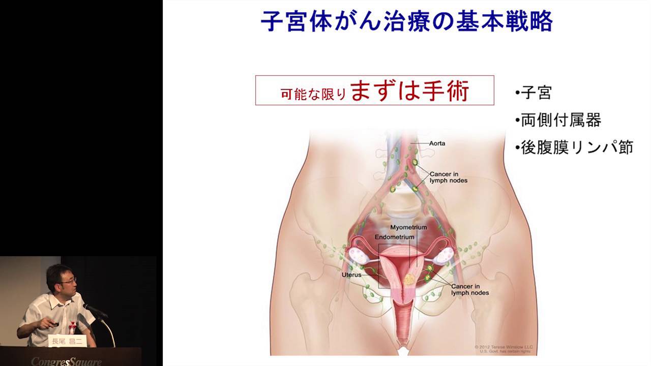 子宮体がん&ldquo;子宮体がん治療の最新情報&rdquo; 長尾 昌二