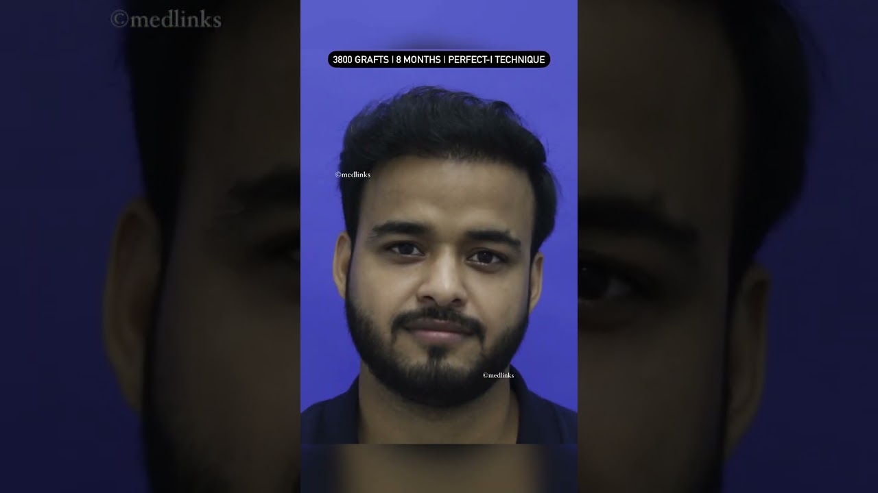 {2024) 🔥 Best Hair transplant result After 8 Months 