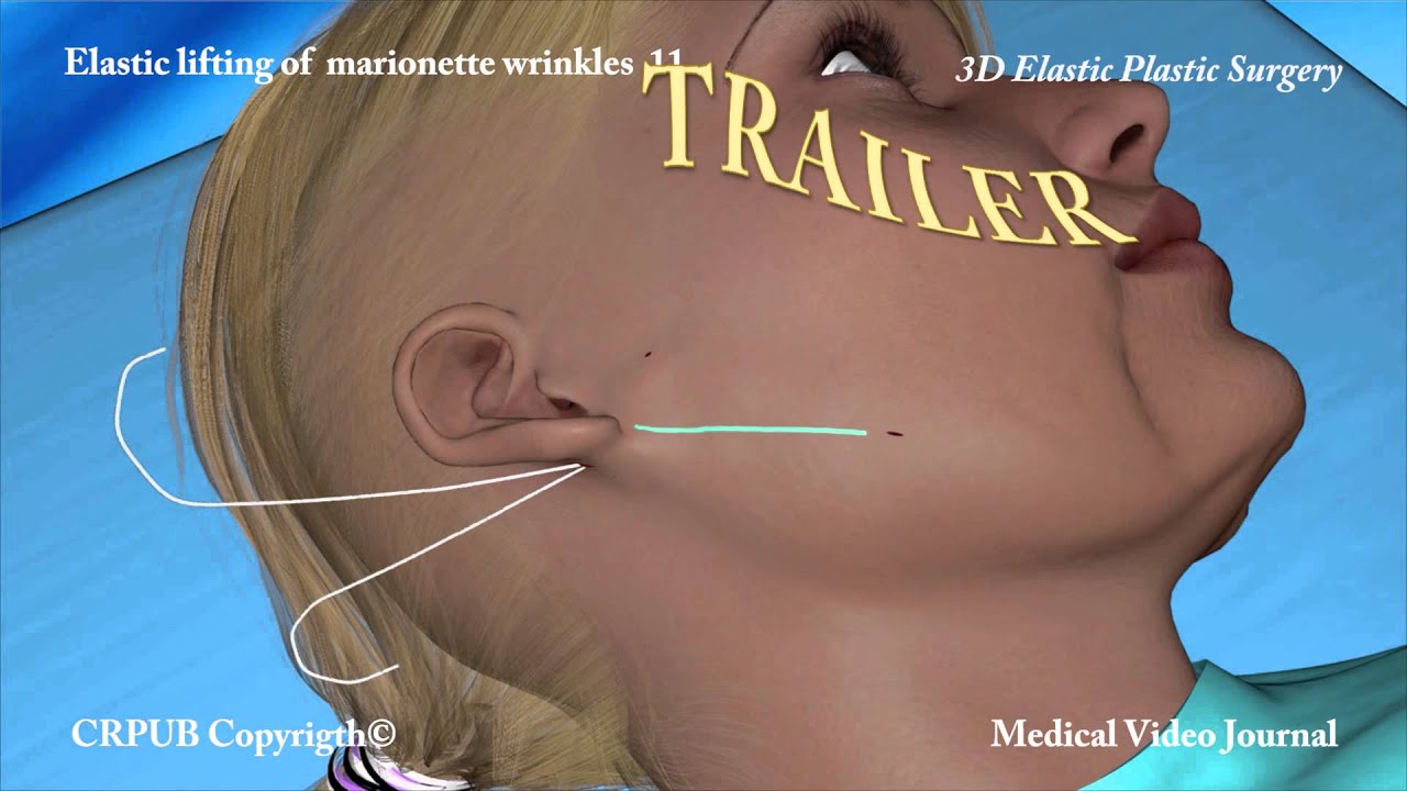 3D Elastic lifting of marionette wrinkles  11