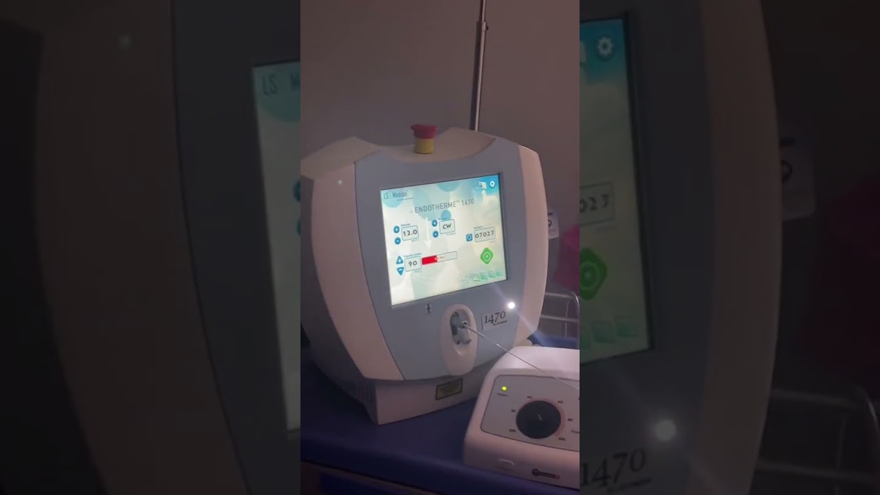 محتار في علاج الدوالي شوف الفيديو عشان تعرف كل حاجة عن عملية قسطرة الليزر للدوالي مع د. حسام المهدي