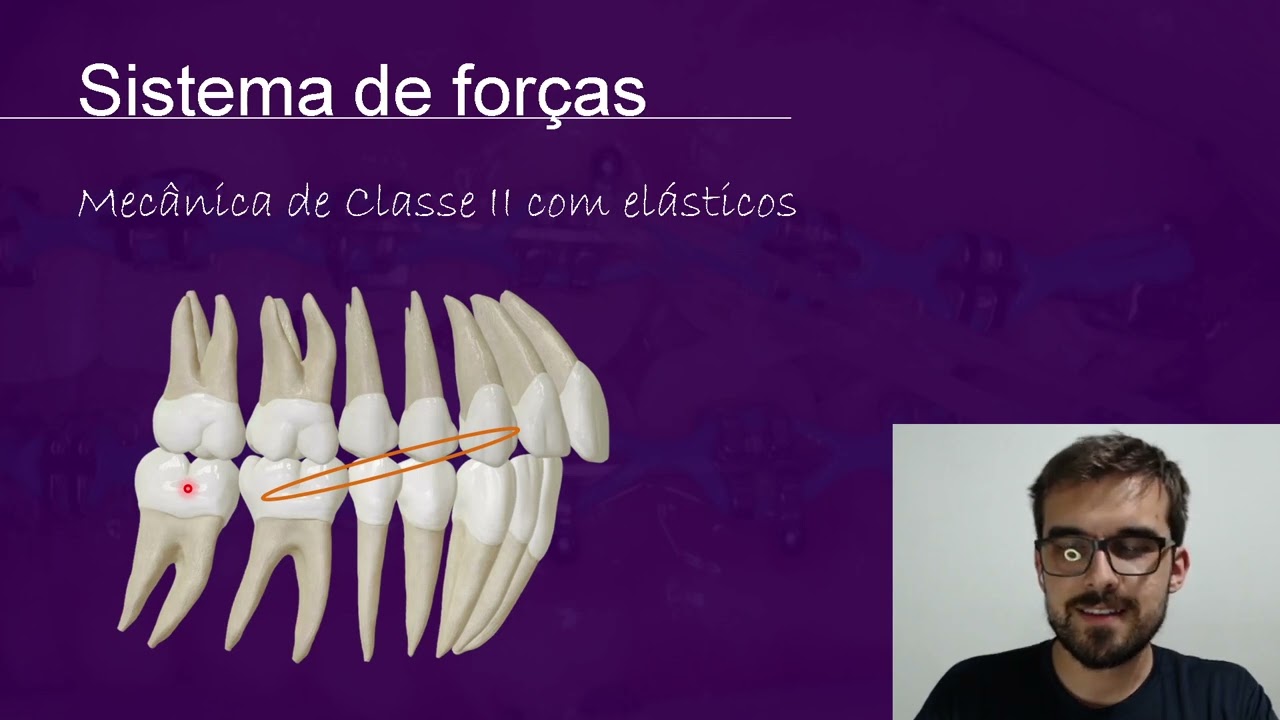 Elástico de Classe II | Resumo de Ortodontia