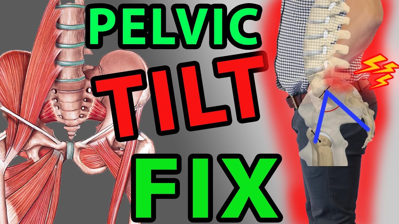 Best Fix Anterior Hip Tilt 1 Minute Exercises | Pelvic Tilt