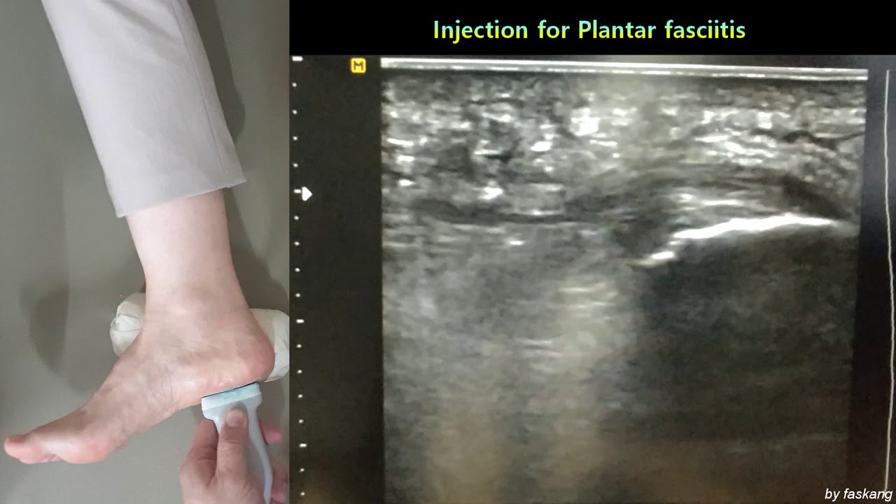 137.(의사용.Dx & Tx under US) Injection therapy for Plantar fasciitis. 족저근막염에서 Steroid 주사 [강찬.충남대.Chan]