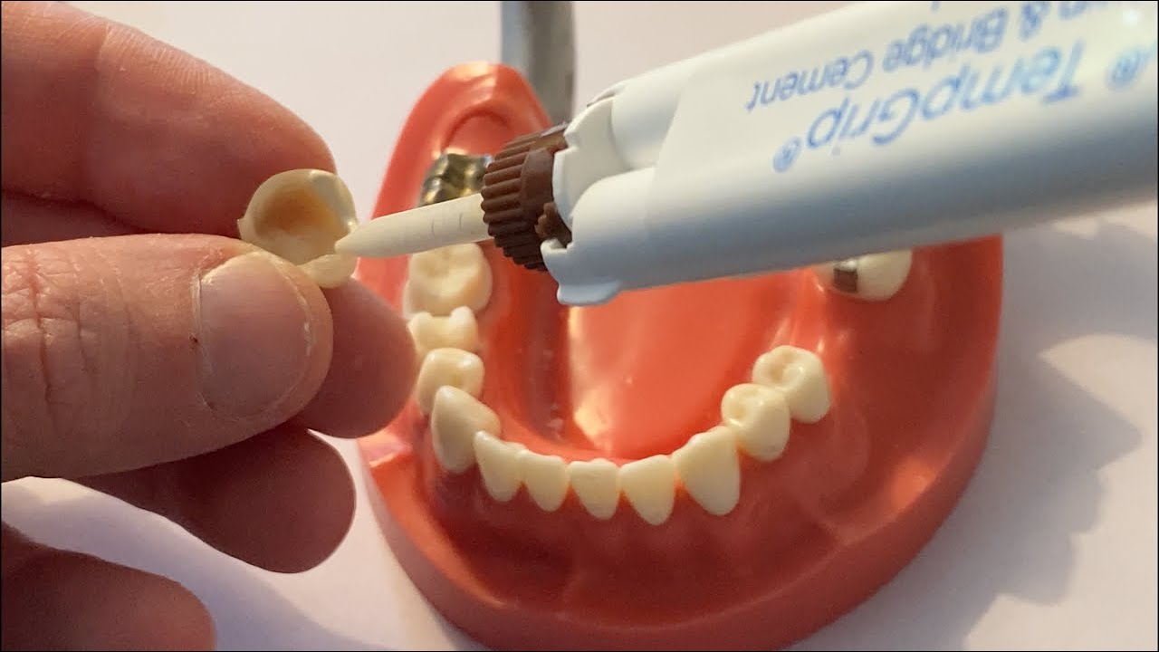 Hey Doc, how much temporary cement should I use, and what type should I use?