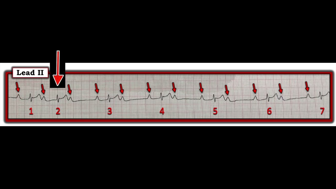 ECG Video Blog #404 &mdash; Mobitz I, Mobitz II or neither? (11-16-2023)