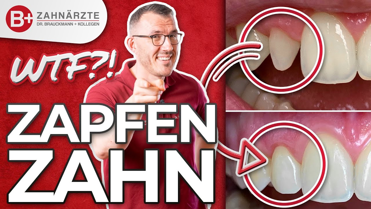 Alles zum Zapfenzahn - Wie aufbauen? Mit Veneer diesen Patientenfall lösen? Inkl. Vorher-Nachher