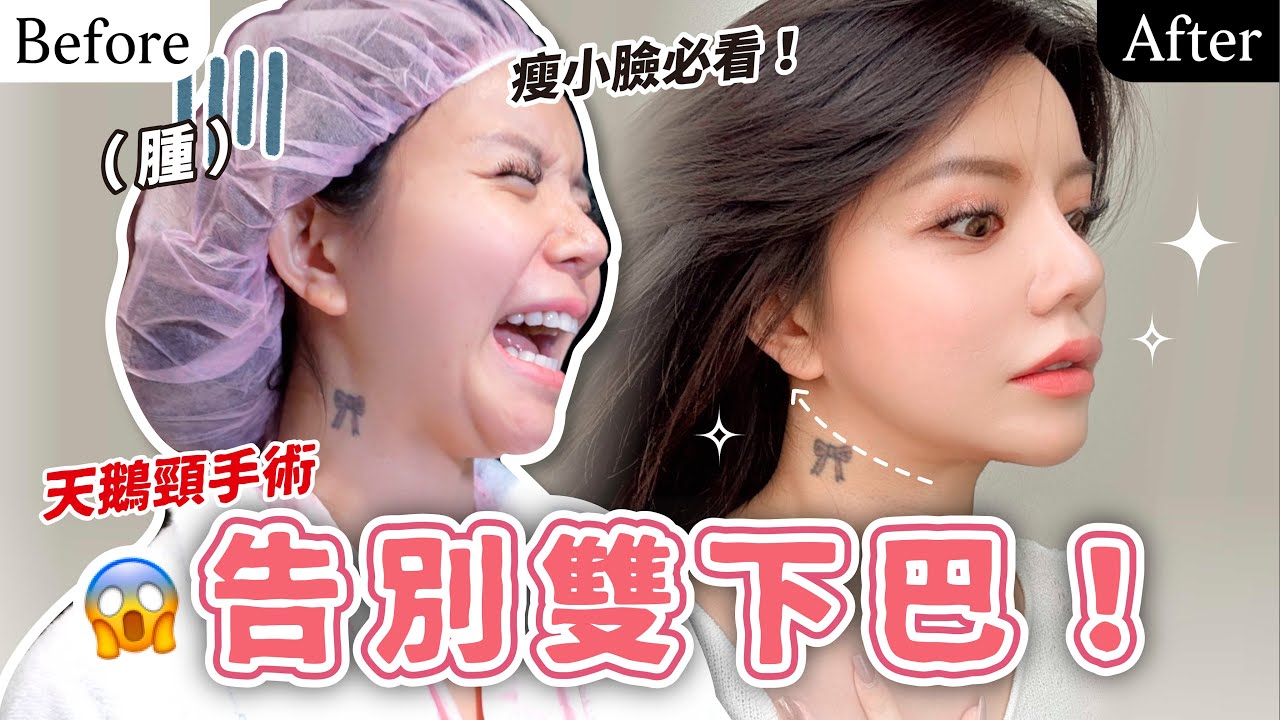 視覺減5公斤！天鵝頸手術是什麼？雙下巴掰掰✋🏻