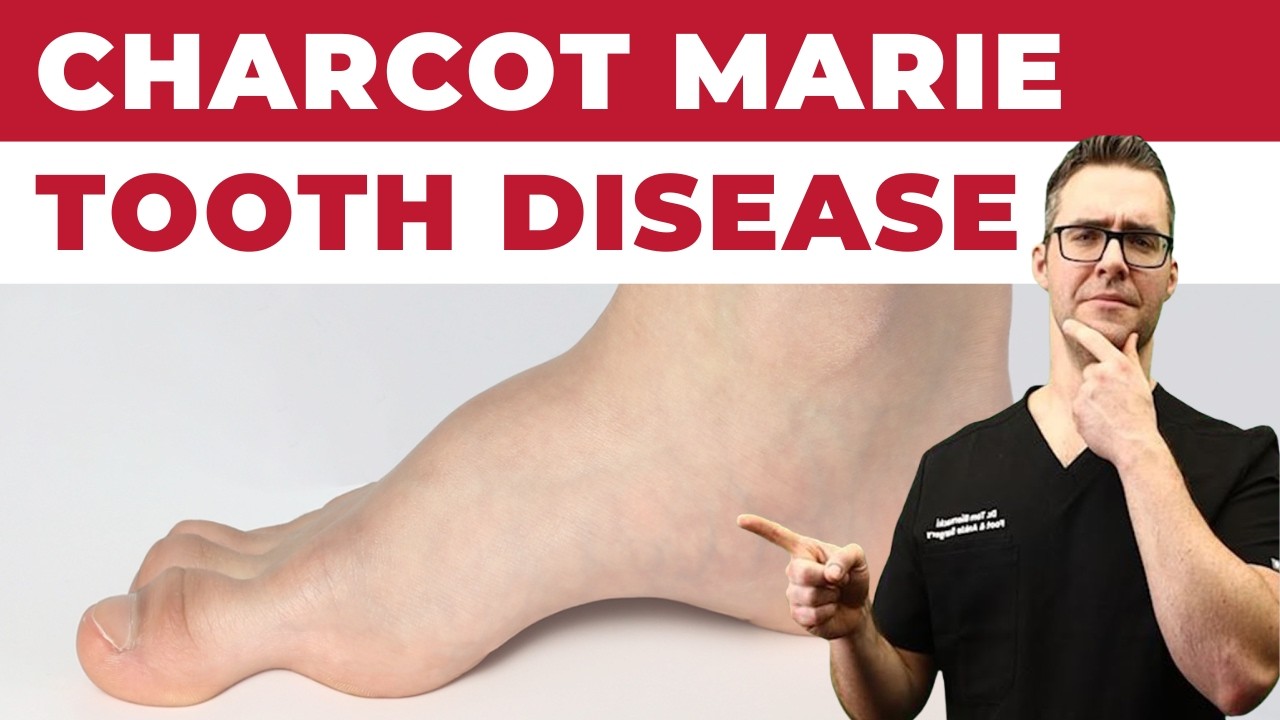 Болезнь зуба Шарко-Мари [Лучшее средство для ног 2022 года!]