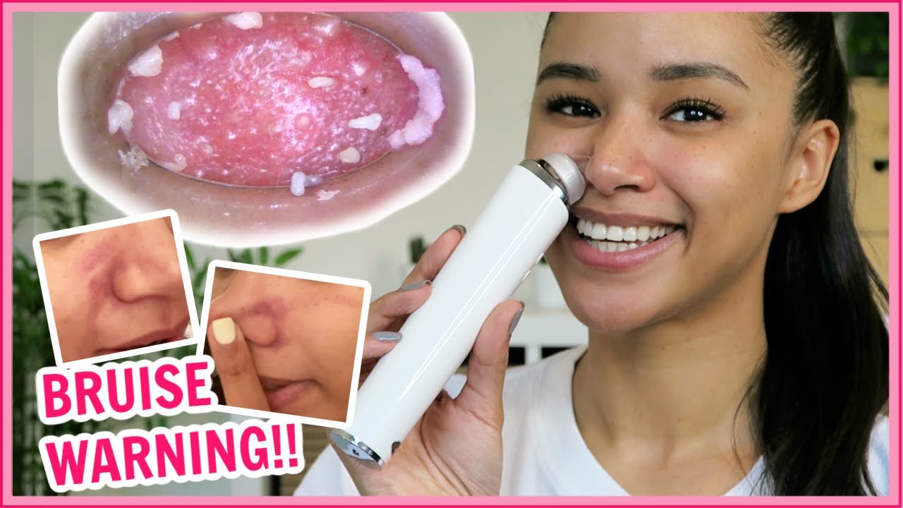 BLACKHEAD VACUUM WITH CAMERA REVIEW + skin damage warning! WATCH BEFORE YOU USE