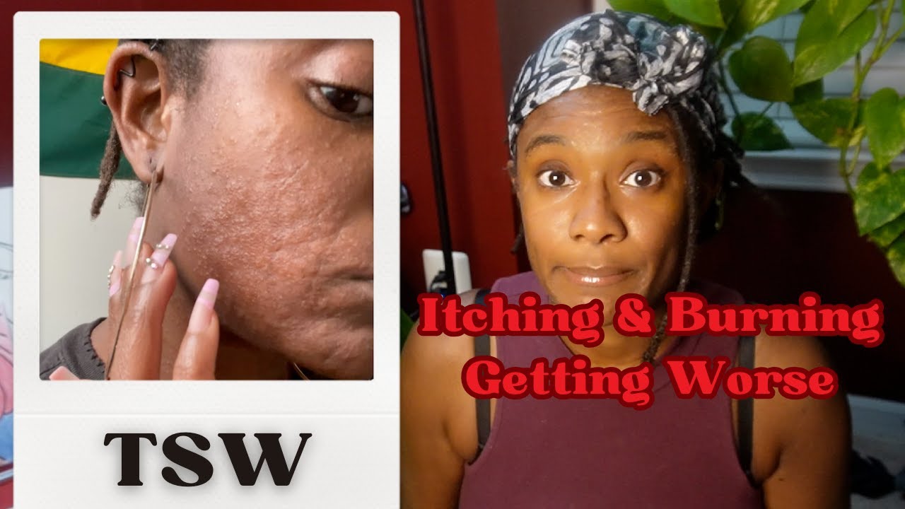 Is your ECZEMA getting WORSE? | #topicalsteroidwithdrawal