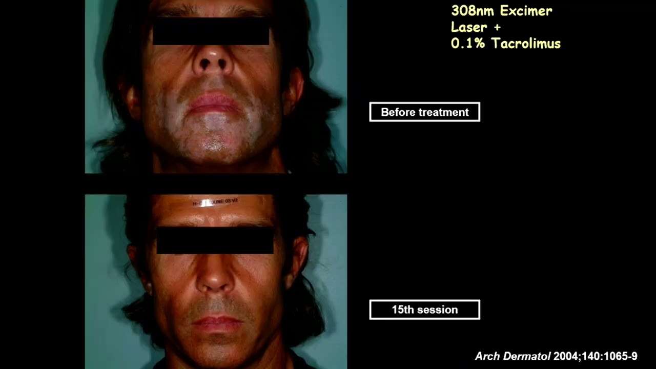 Invited Speaker: Optimizing Combination Therapies for the Best Results in Vitiligo