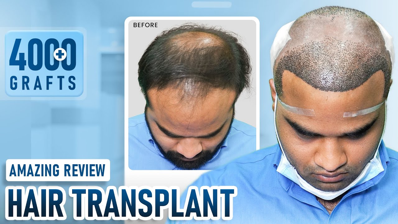 Grade 5 Hair Transplant| 4400 Grafts FUE | Hairfree & Hairgrow Ahmedabad | Dr Richa Sanmukhani