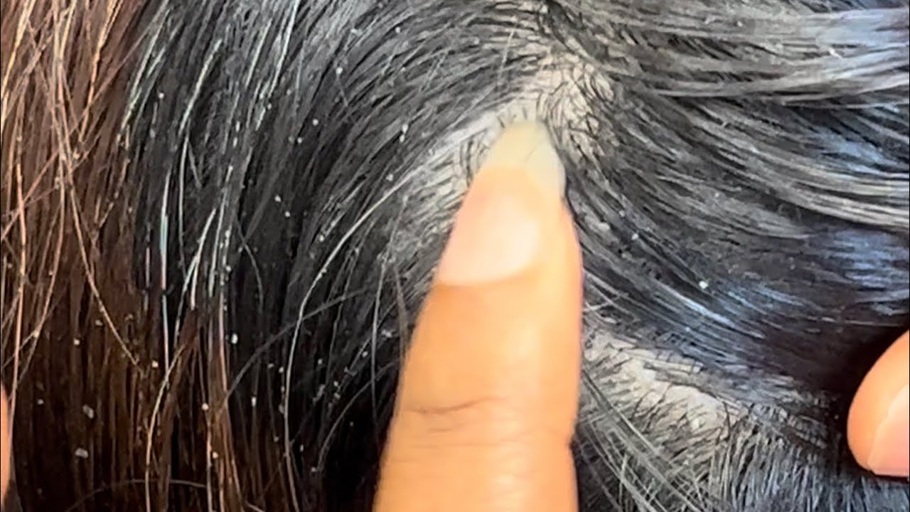 ASMR✨Scalp Transformations on All Hair Textures | Real Dandruff & Lice Removal
