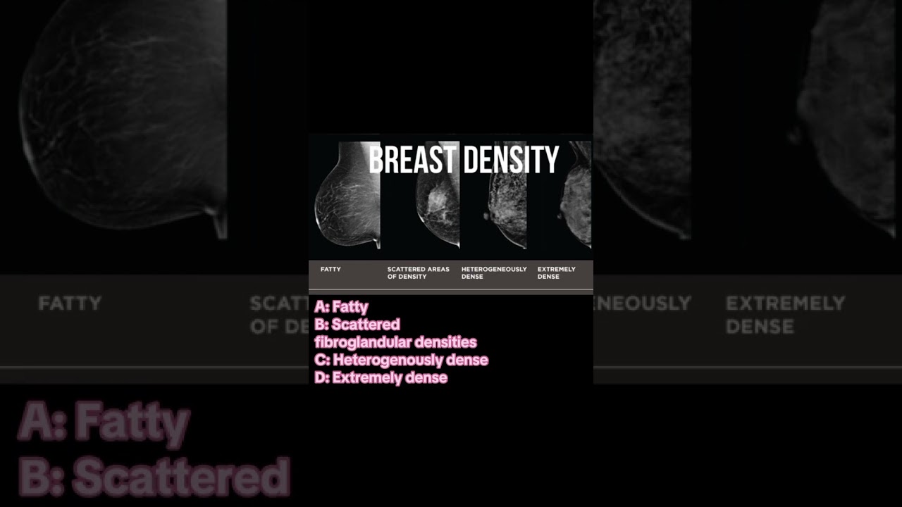 Examples of Category C Dense Breasts on a Mammogram