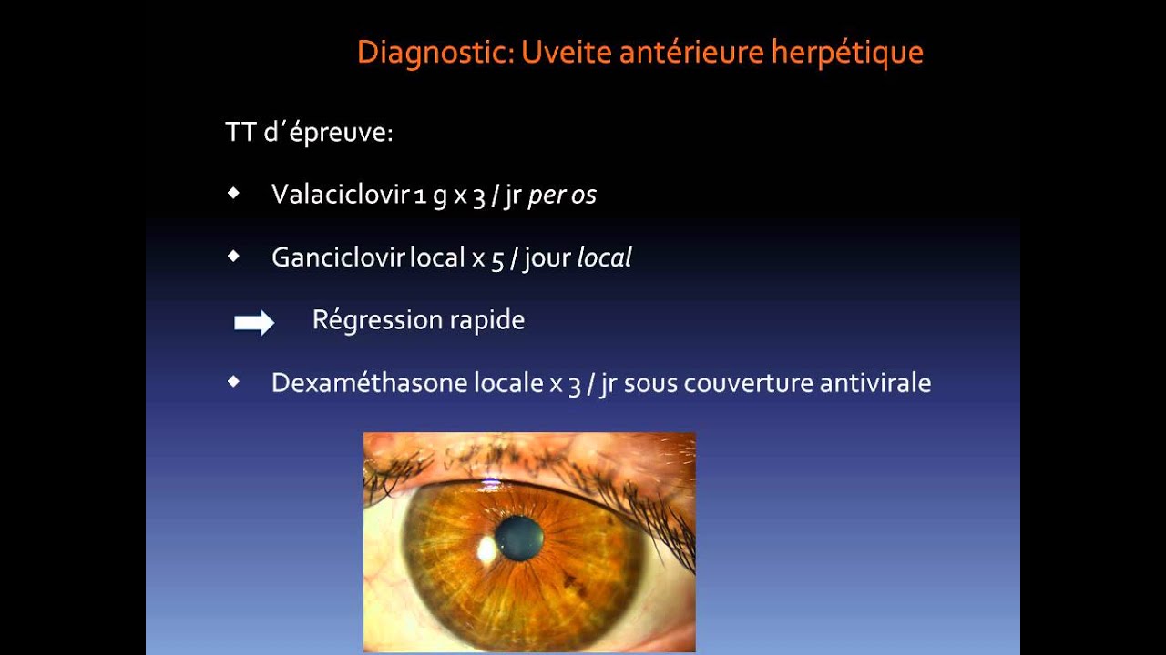 Laser SLT, Huebert I. et coll.