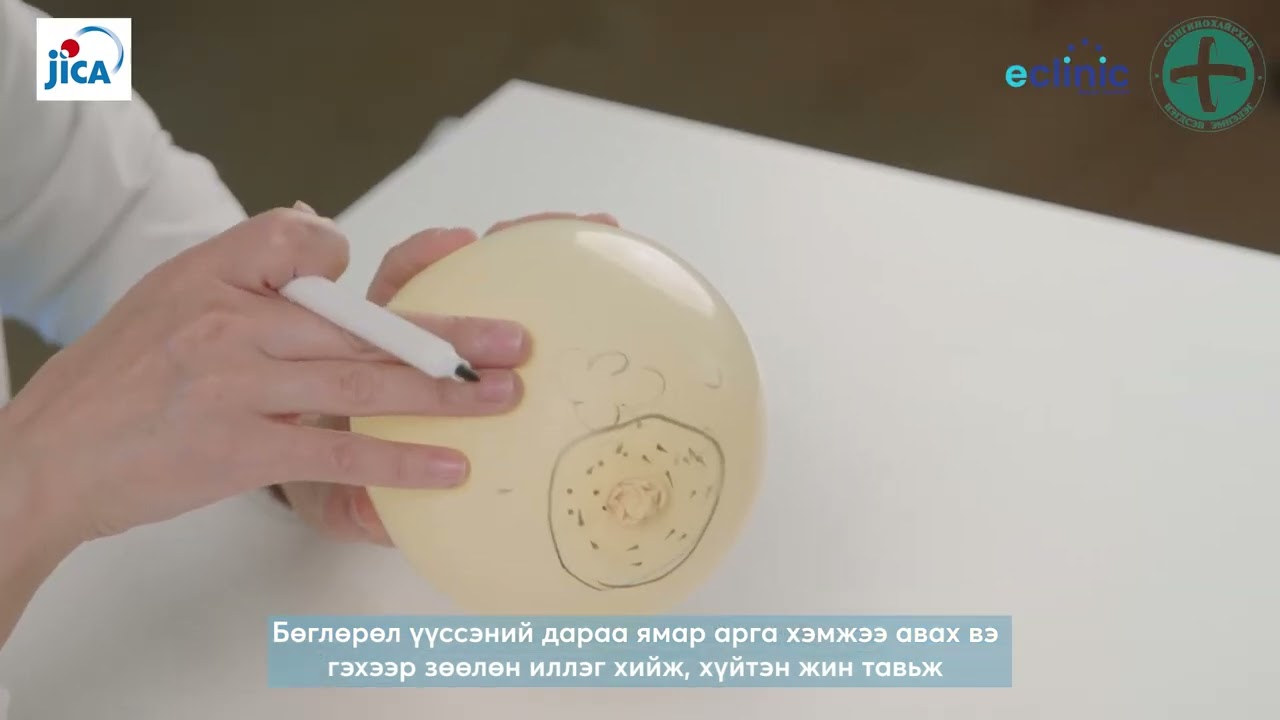 Хөхний сувгийн бөглөрөл
