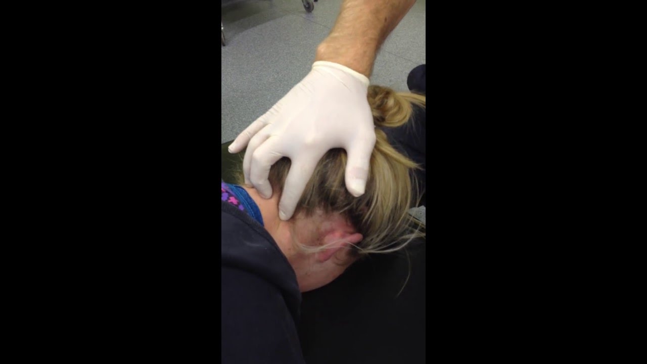Suboccipital Dry Needling