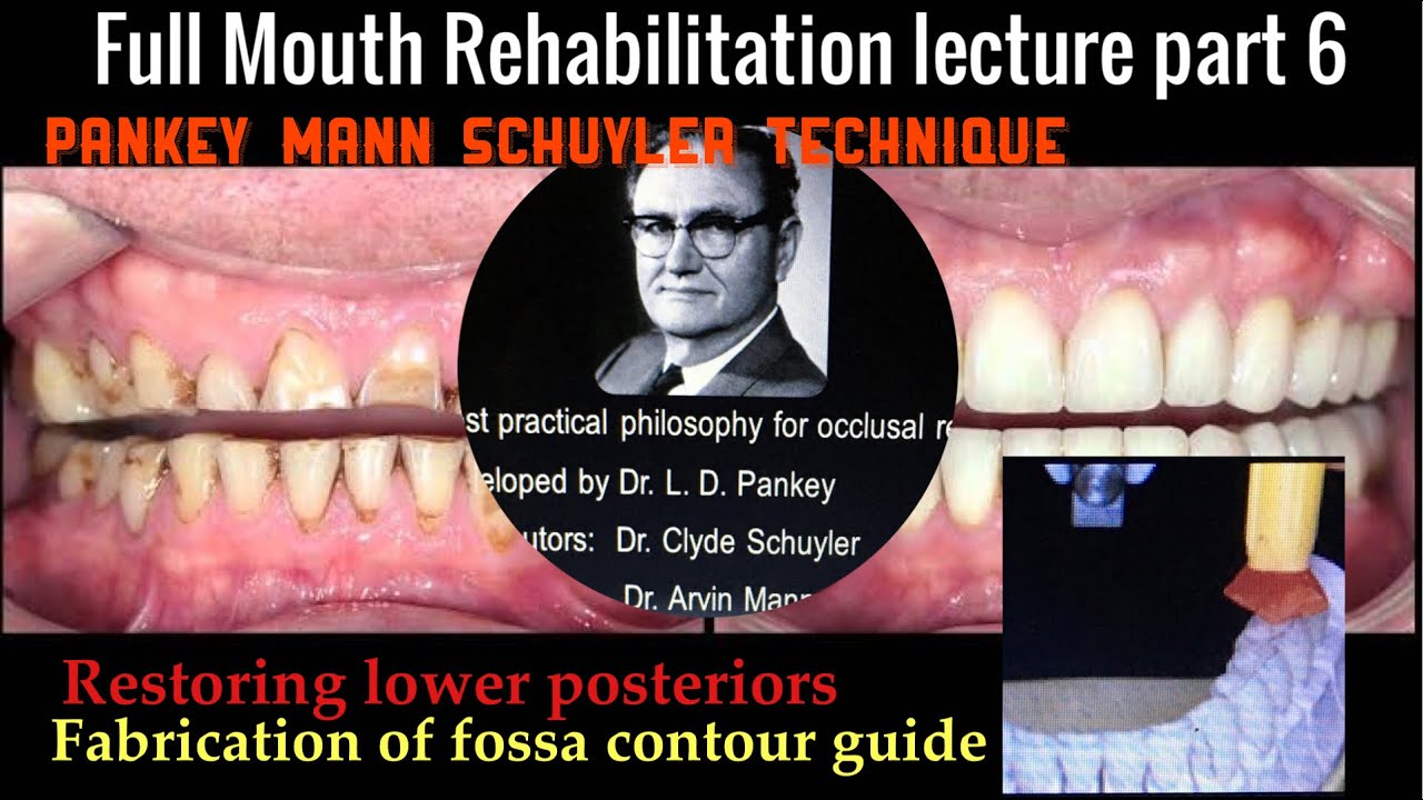 Лекция по полной реабилитации полости рта, часть 6. Восстановление жевательных зубов по методике ...
