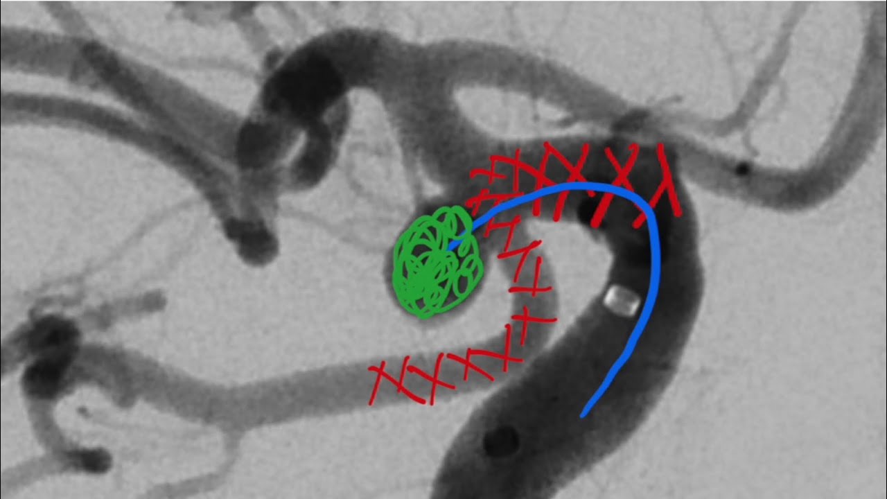 (Deutsch) Aneurysma der Arteria communicans posterior (PCOM), stent-assistierte Coilembolisation