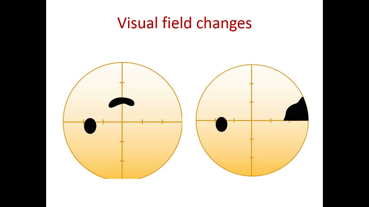 Primary open angle glaucoma - By/ Dr. Mortada Ahmed Abozaid