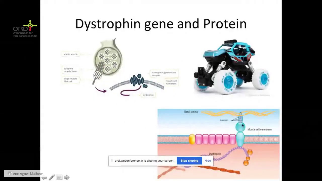 Living with DMD & Neuromuscular Disorders During A Pandemic Webinar Series with Dr Ann Agnes Mathew