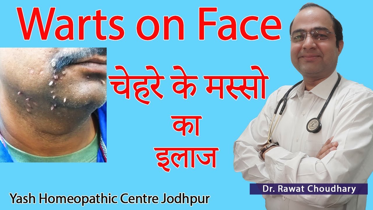 Warts on Face | मस्सो का इलाज | Best Treatment of Warts | Best Homeopathic Doctor in India