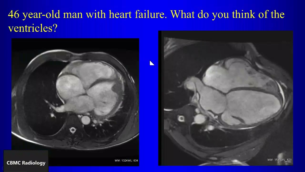 Cardiac and Pericardial Tumors