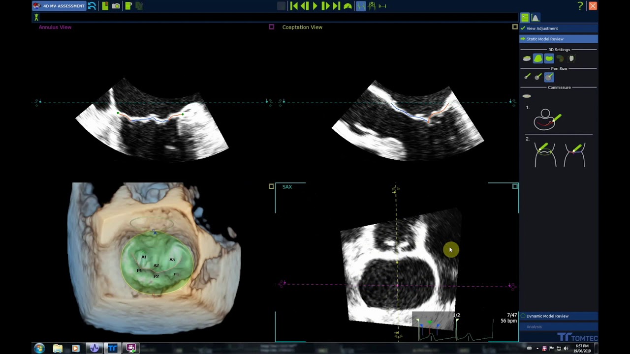 Mitral Valve Analysis: TomTec