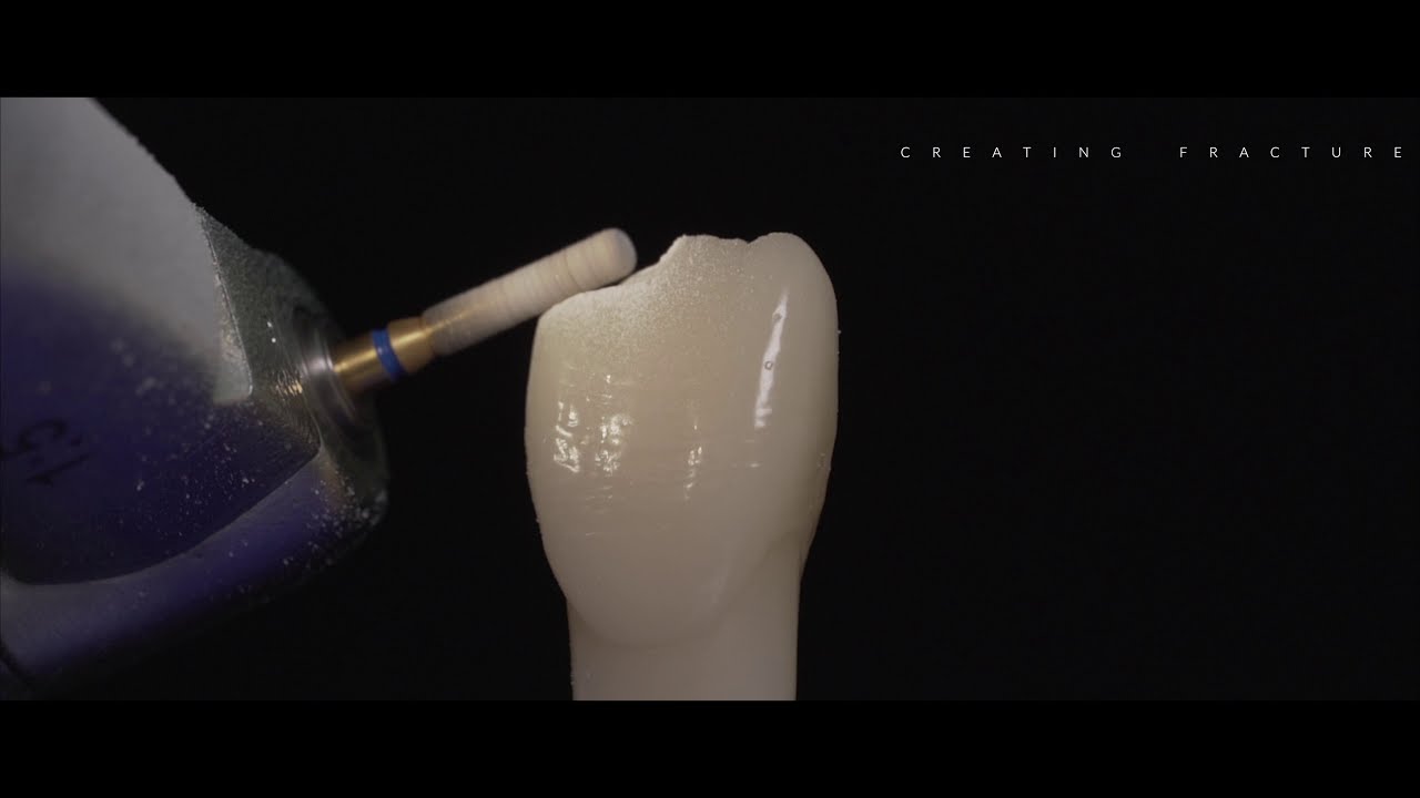 Simple Class IV Anterior Composite Restoration Presented by Dr. Rhodri Thomas