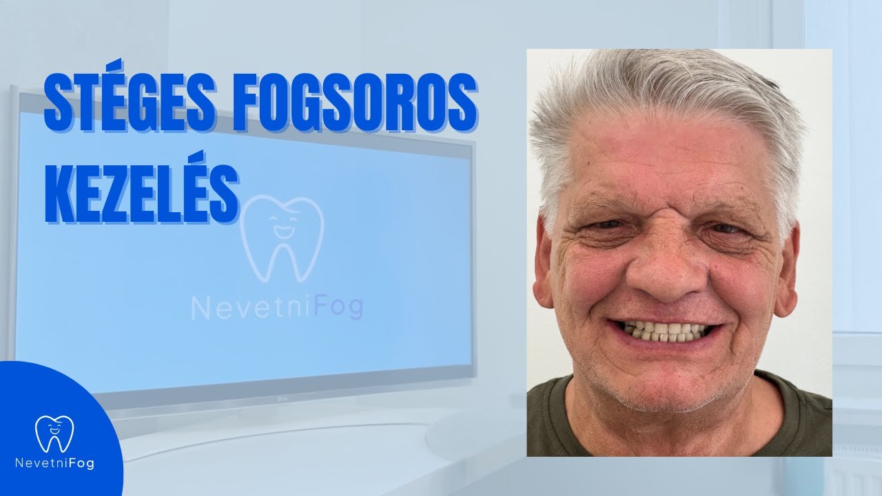 Stéges Fogsor Tapasztalat | „Rávettem magam, és belevágtam” | NevetniFog