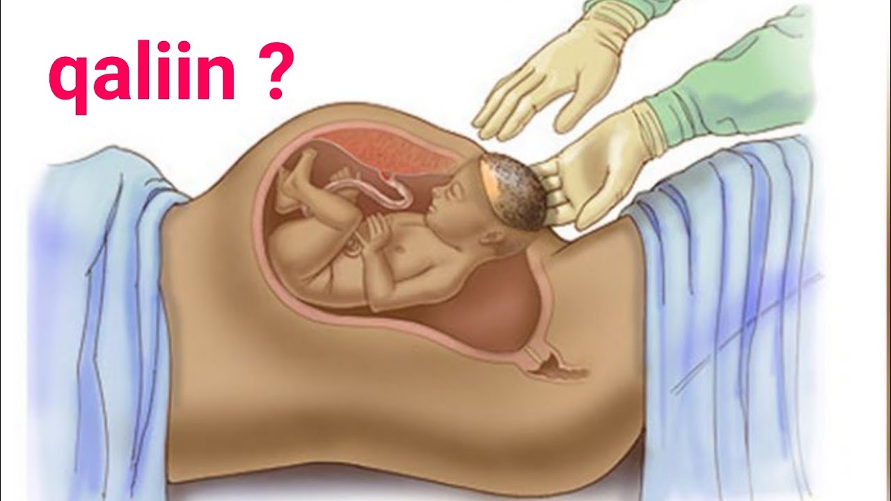 inaa qaliin ku dhasho  maxaa sababo ??#Dhiig la aanta