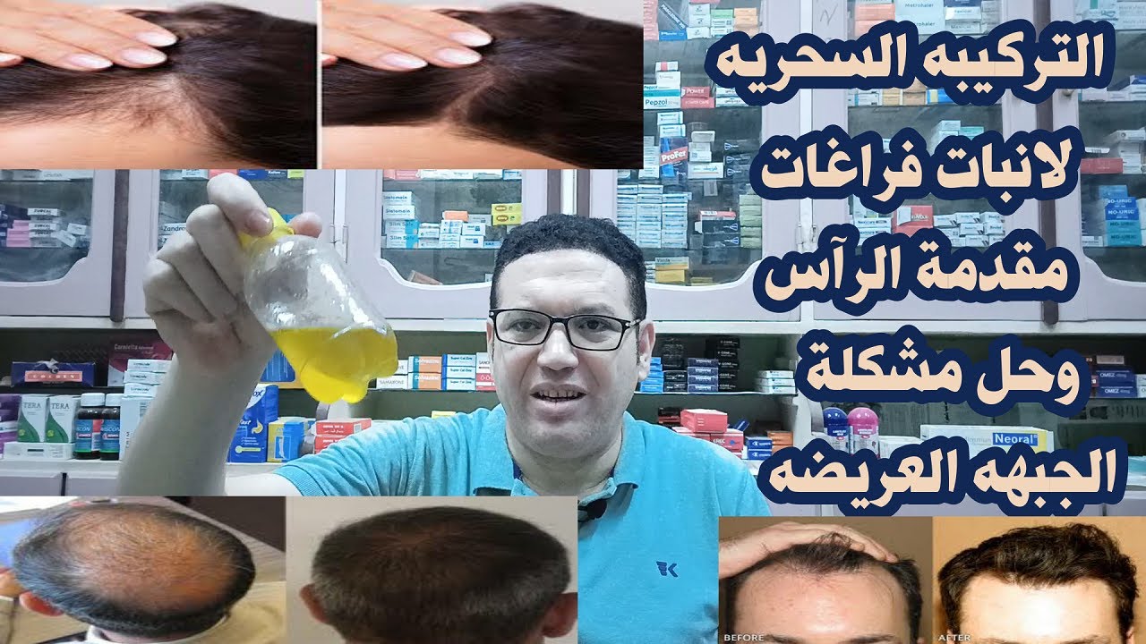 افضل تركيبه لانبات فراغات مقدمة الرآس ونطويل وتكثيف الشعر/وعلاج الصلع الوراثئ وملئ فراغات فروة الراس