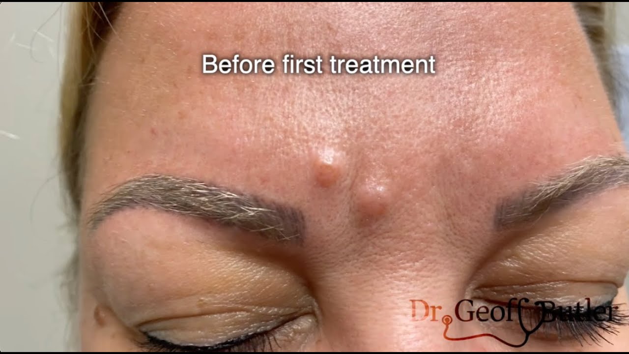 An alternative way to remove facial lesions without scarring - using liquid nitrogen