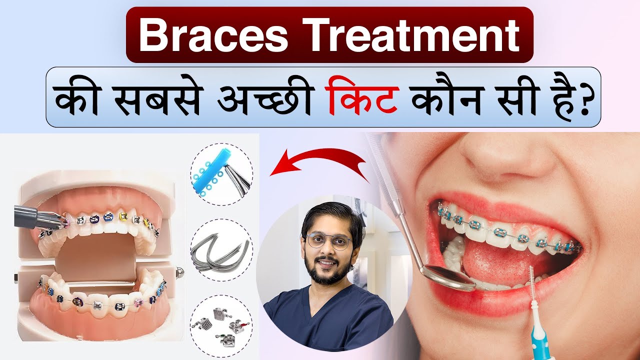 Braces में अच्छी Kit का महत्व 😬🦷 | कौन-सी Braces Kit चुनें? | Best Orthodontist in Indore