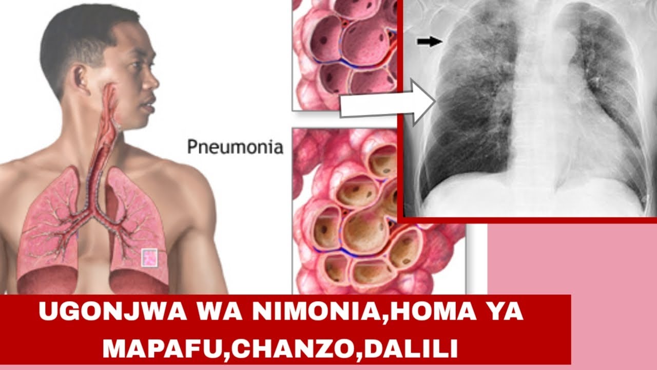 UGONJWA WA NIMONIA,HOMA YA MAPAFU,CHANZO,DALILI NA TIBA