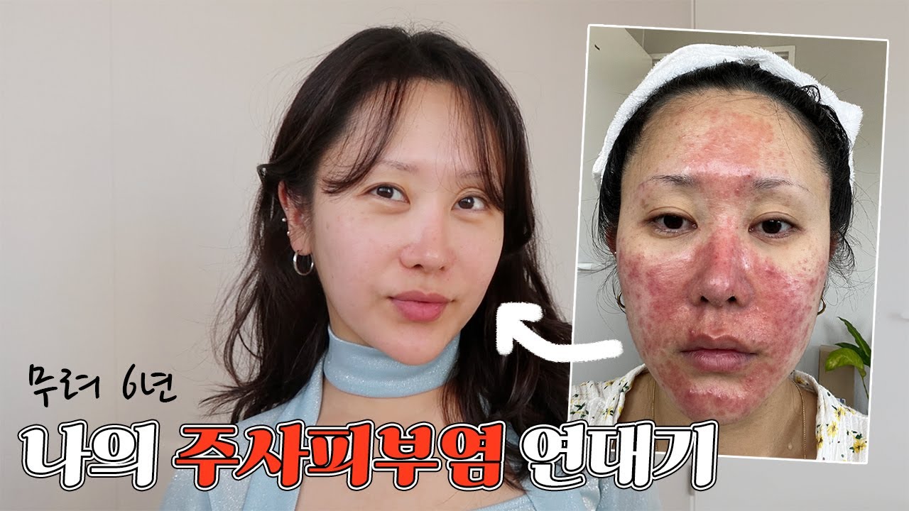 피부 근황? 병원? 피부 관리법? 나의 주사피부염 연대기