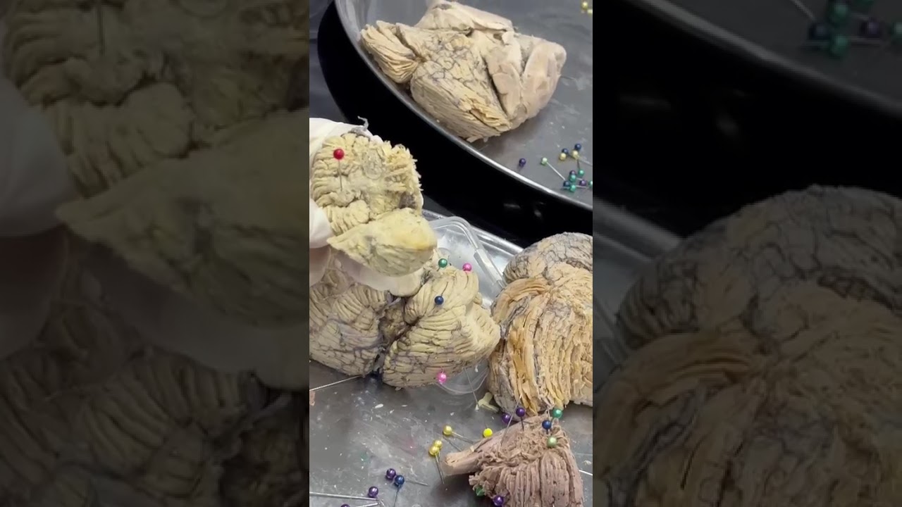 Cerebelo parte 2