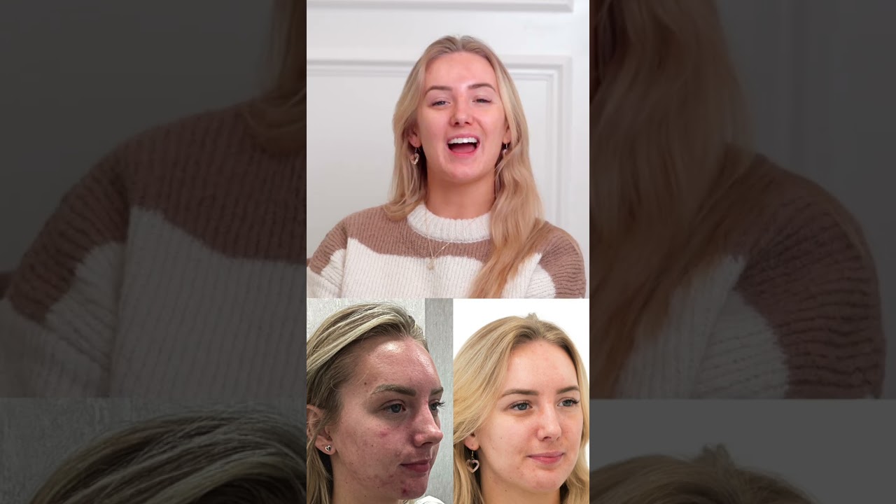 Kirsty’s Acne Journey | Real Results & Clearer Skin at Este Medical Group