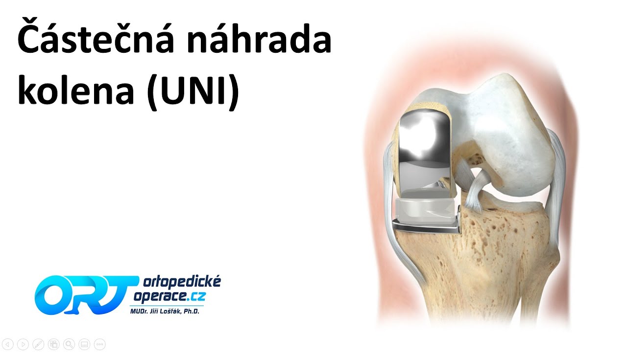 Částečná náhrada kolena (UNI)